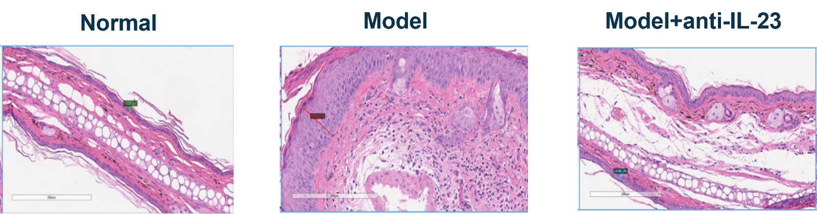 Psoriasis histology.png