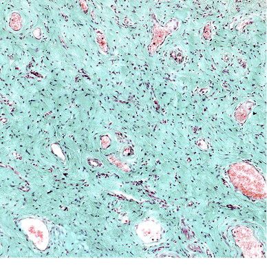 Development of high-affinity decoy receptors to treat multiple myeloma and diffuse large B cell lymphoma
